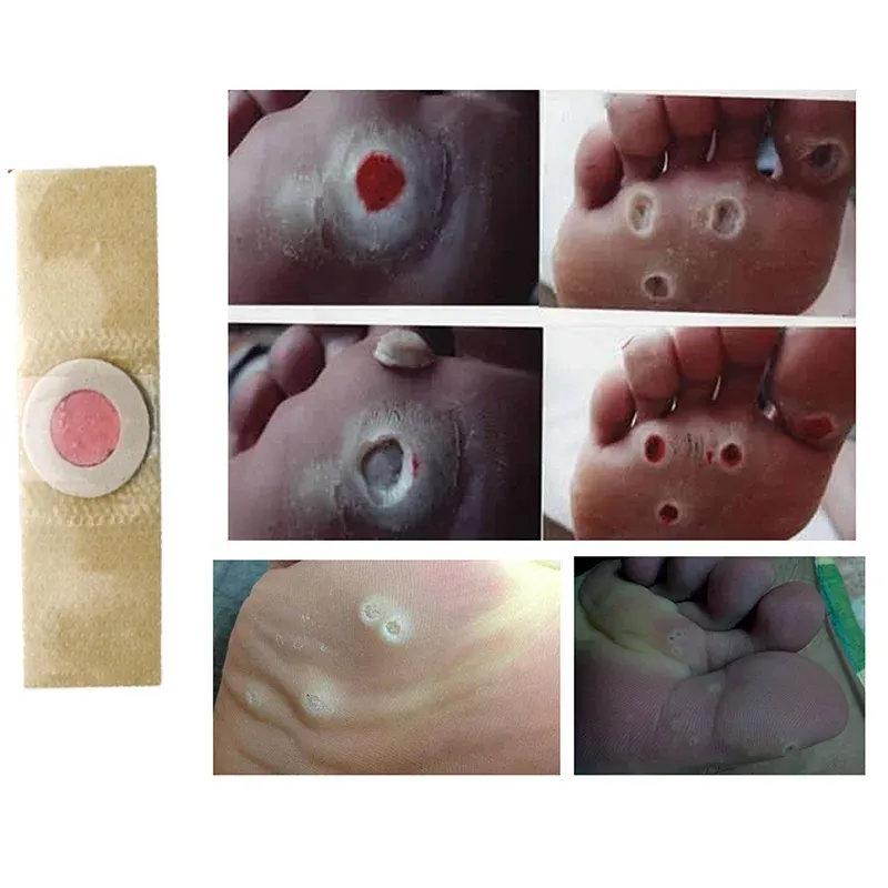 Patchs adhésifs pour callosités