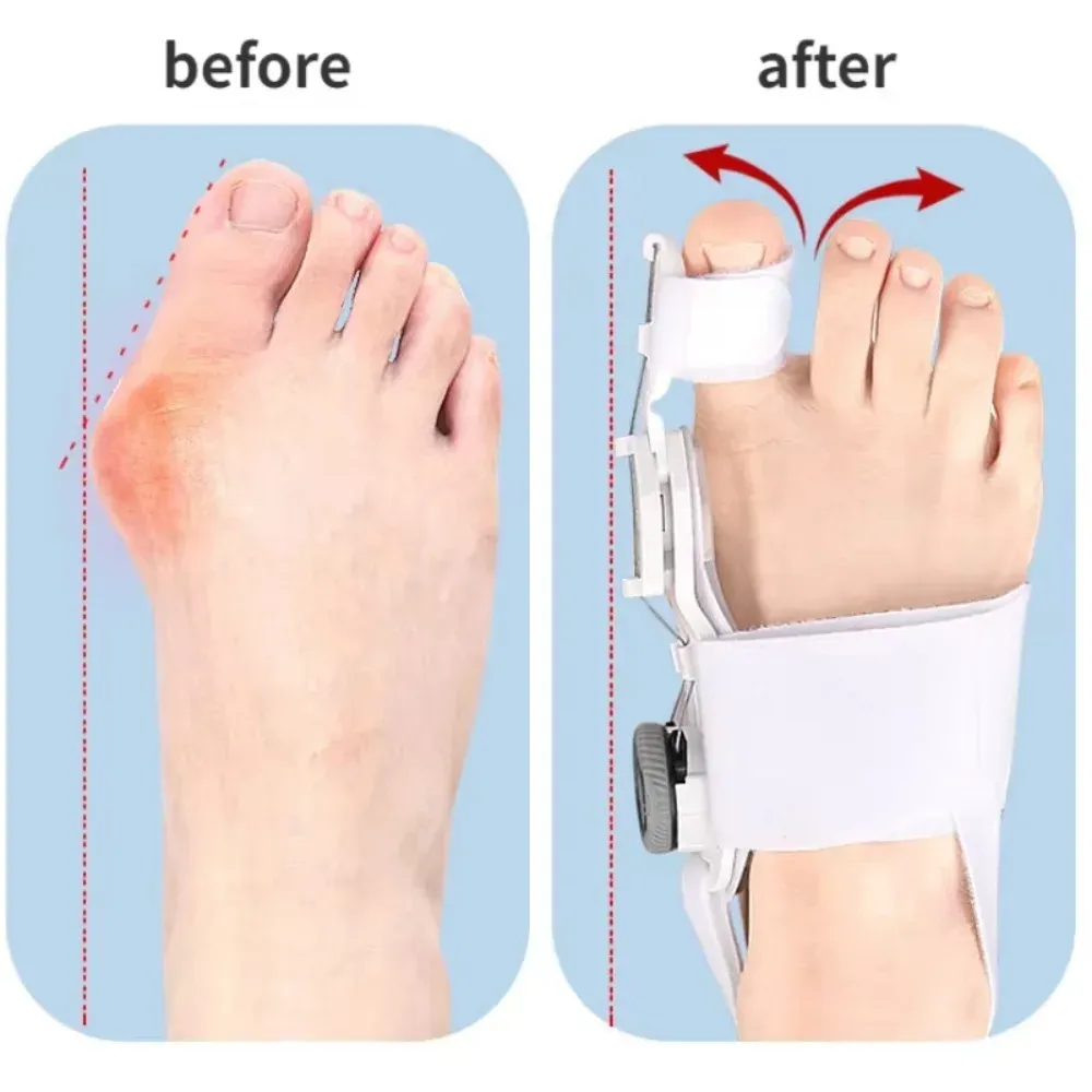 Correcteur d'hallux valgus, mise en situation