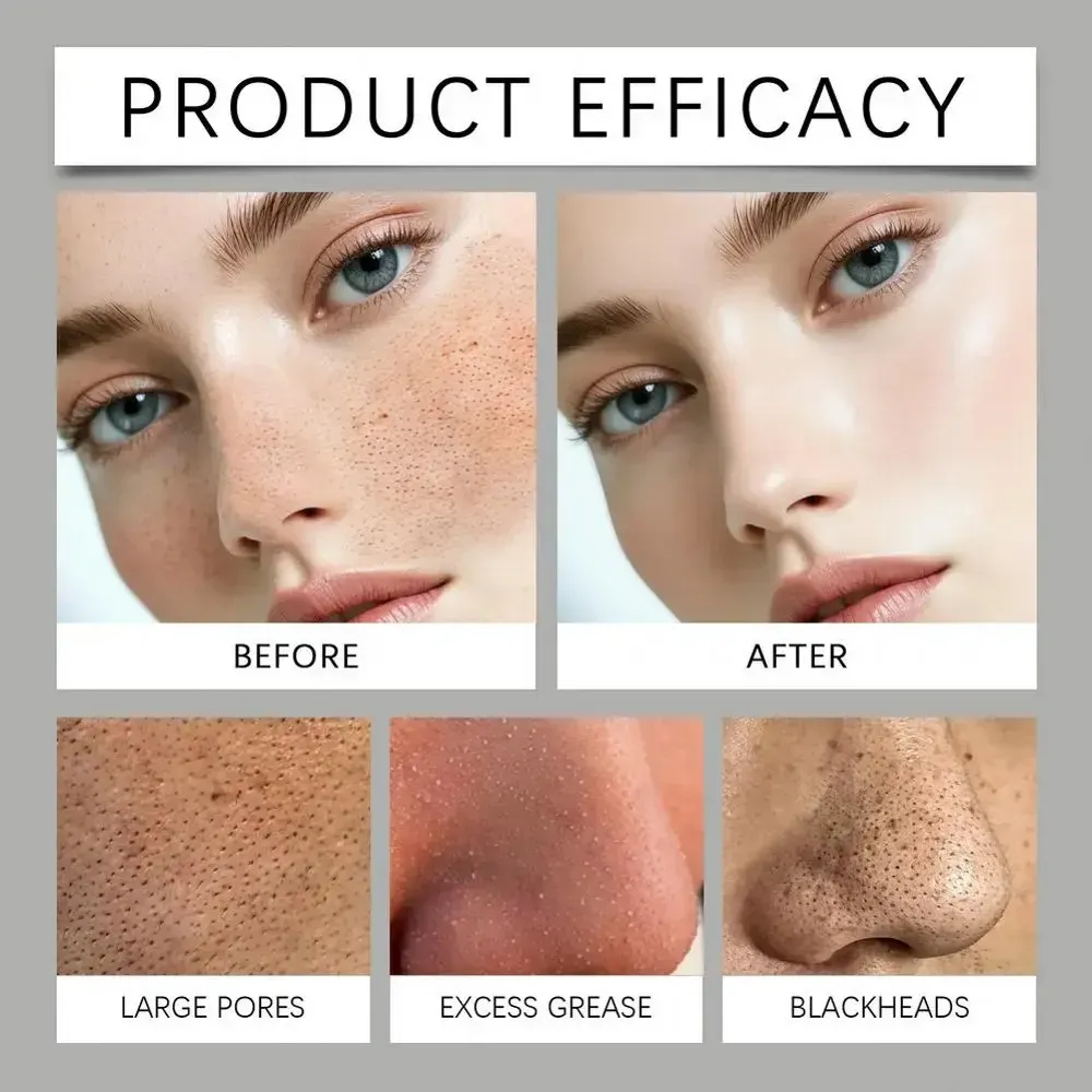 Appareil d'aspiration des points noirs, soin du visage