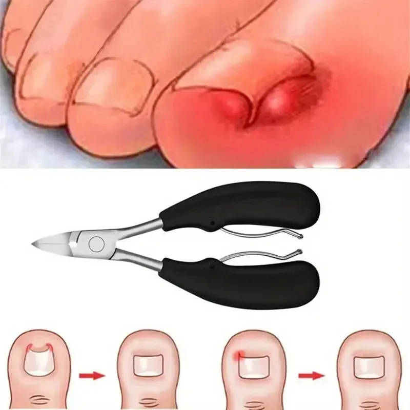 Ensemble de coupe-ongles épais pour ongles incarnés, coupe-ongles robuste de qualité podologue, repousse-cuticules, manucure et pédicure, outils pour ongles 6