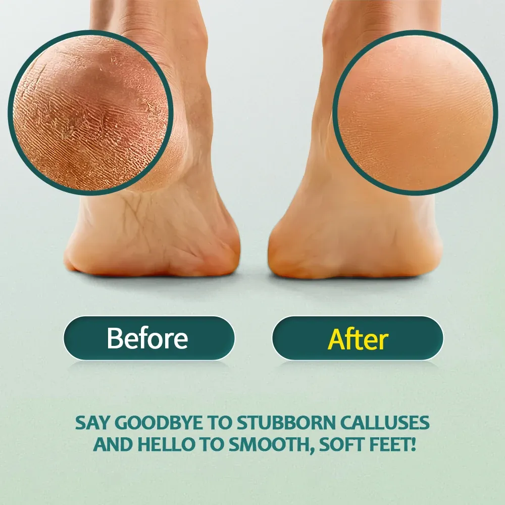 Nailpop – Dissolvant de callosités professionnel pour pieds, gel extra résistant et râpe, lime à pieds, dissolvant de peau morte pour talons craquelés et peau sèche 2